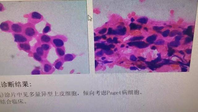 皇冠信用盘怎么弄_以为是湿疹皇冠信用盘怎么弄，结果竟是癌！宁波女子悔惨：反复涂了一年药膏都没好！很多患者首诊都去了皮肤科